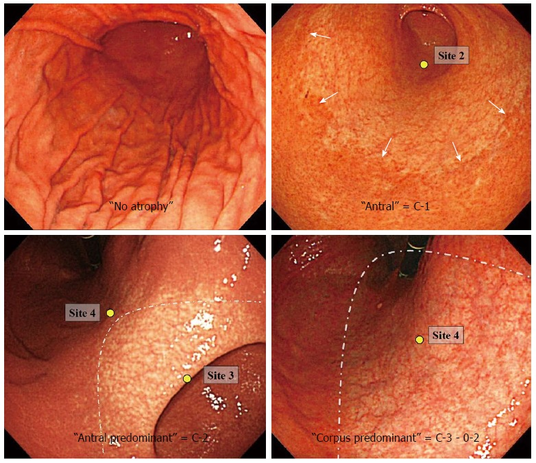 IBDGastroDocSg's tweet photo. Kimura-Takemoto classification
- classifies atrophic gastritis by locating the atrophic border in the stomach
- closed: border remains on the lesser curve
- open: border extends into anterior and posterior walls of the stomach

#GITwitter https://t.co/F2BnnRYTq8