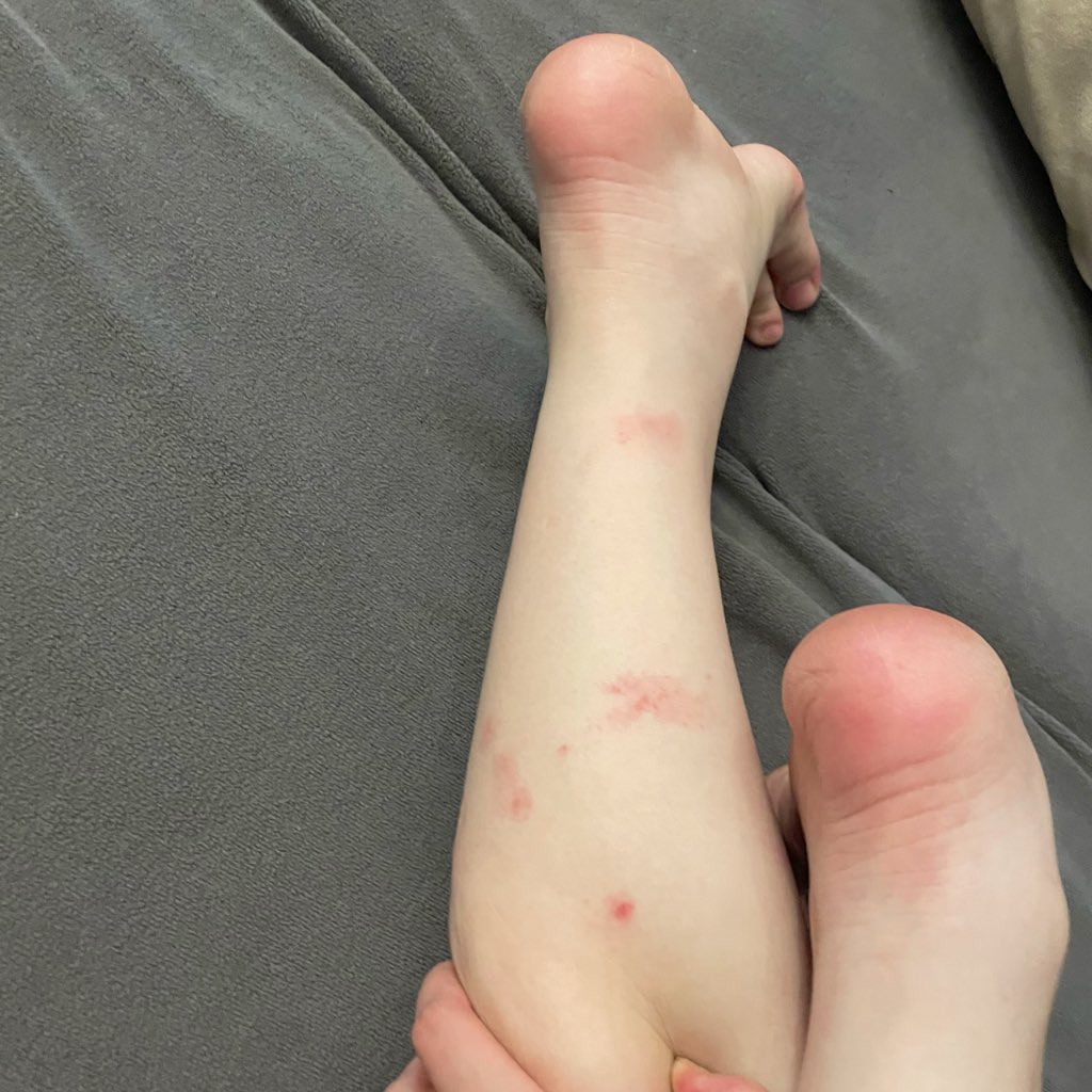死蚊子，你欠我的拿什么还😭😭😭😭😭😭😭 https://t.co/Yx3BYD0Pre