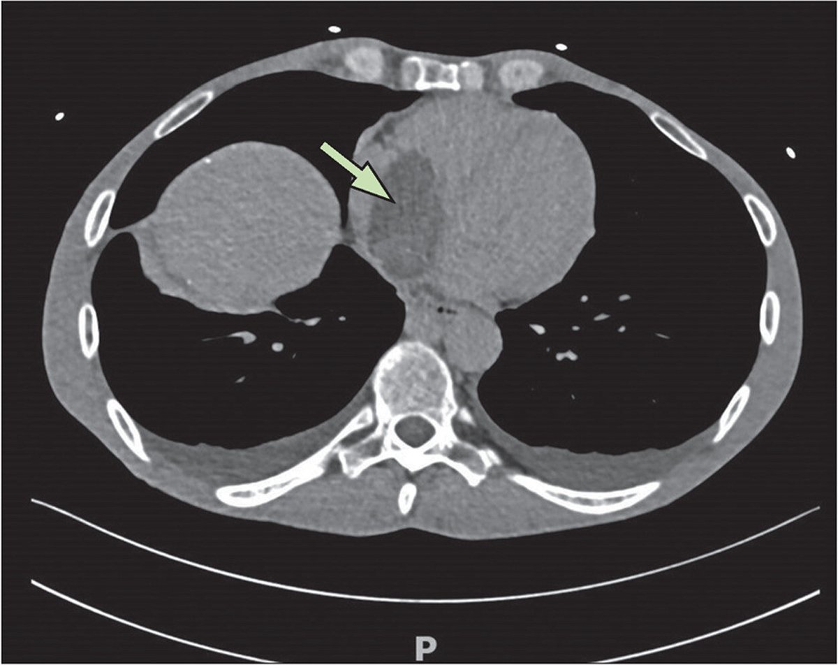 New #TLClinicalPic quiz: 'A right atrial mass and colonic cancer in a patient with Lynch syndrome' Test your medical knowledge & diagnostic skills 👉 hubs.li/Q02ynG4j0
