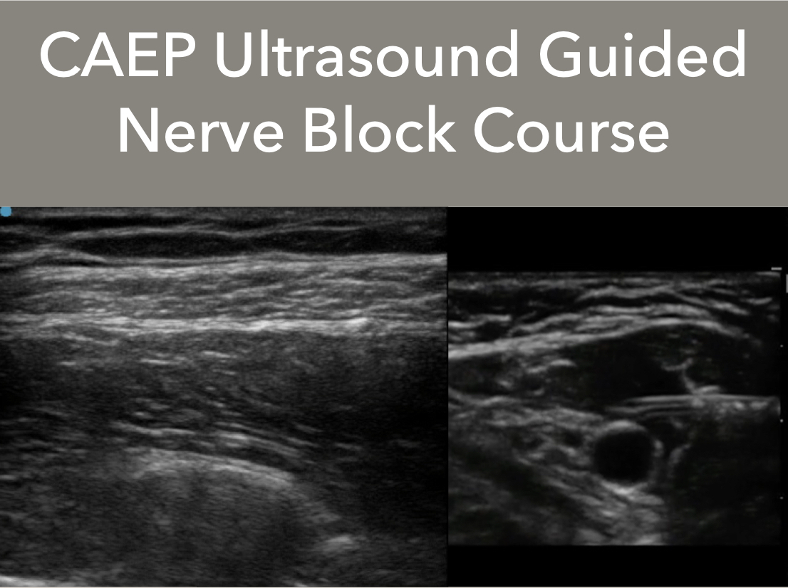 Do you manage patients in pain in #Emergency?

Join us and <a href="/TomJelic/">Tom Jelic</a> at <a href="/CAEPConference/">#CAEP24 Saskatoon</a> in Saskatoon for an Ultrasound Guided Nerve Block course covering adult &amp; pediatric applications. Grow your nerve block skills with hands-on practice.

Sign up: caepconference.ca/pre-conference…