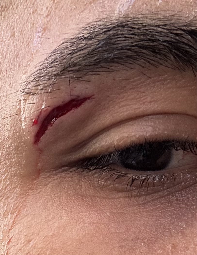 JapanTutorChess's tweet image. Injury update. Day two and the doctor did an amazing stitch job. Looking forward to a speedy recovery