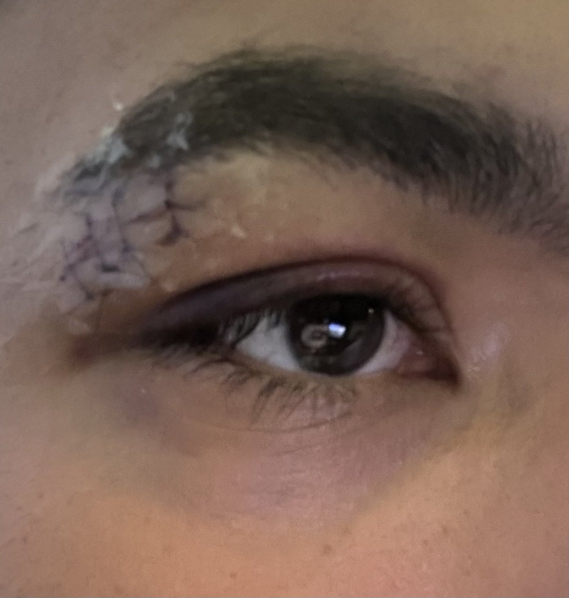 JapanTutorChess's tweet image. Injury update. Day two and the doctor did an amazing stitch job. Looking forward to a speedy recovery