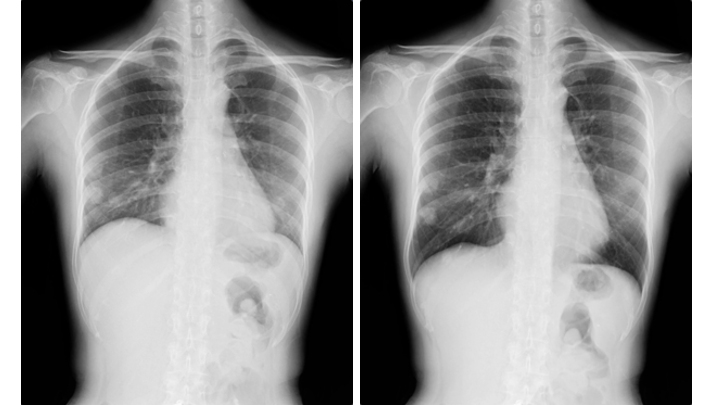 AI-Based Analysis of Dynamic Digital Radiography Data Gives Greater Insight into Lung Function Read more ➡️ bit.ly/4dVT40U @KonicaMinoltaMI #AI #RadNews #Radiology #Xray #DDR