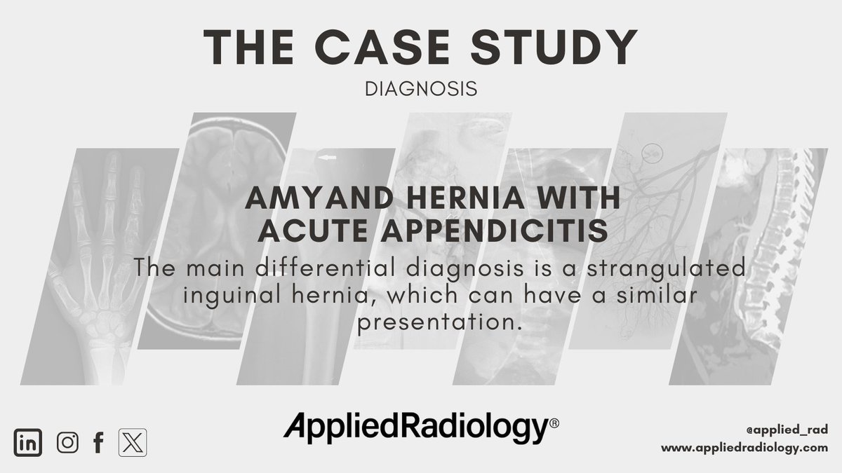 🩻 Case Study of the Week - Diagnosis Time! Amyand hernia with acute appendicitis See all the case details, more images, and diagnosis ➡️ bit.ly/4bsvuHw #RadEd #Radiology #CaseOfTheWeek #RadRes #CaseStudy #COW #MedEd