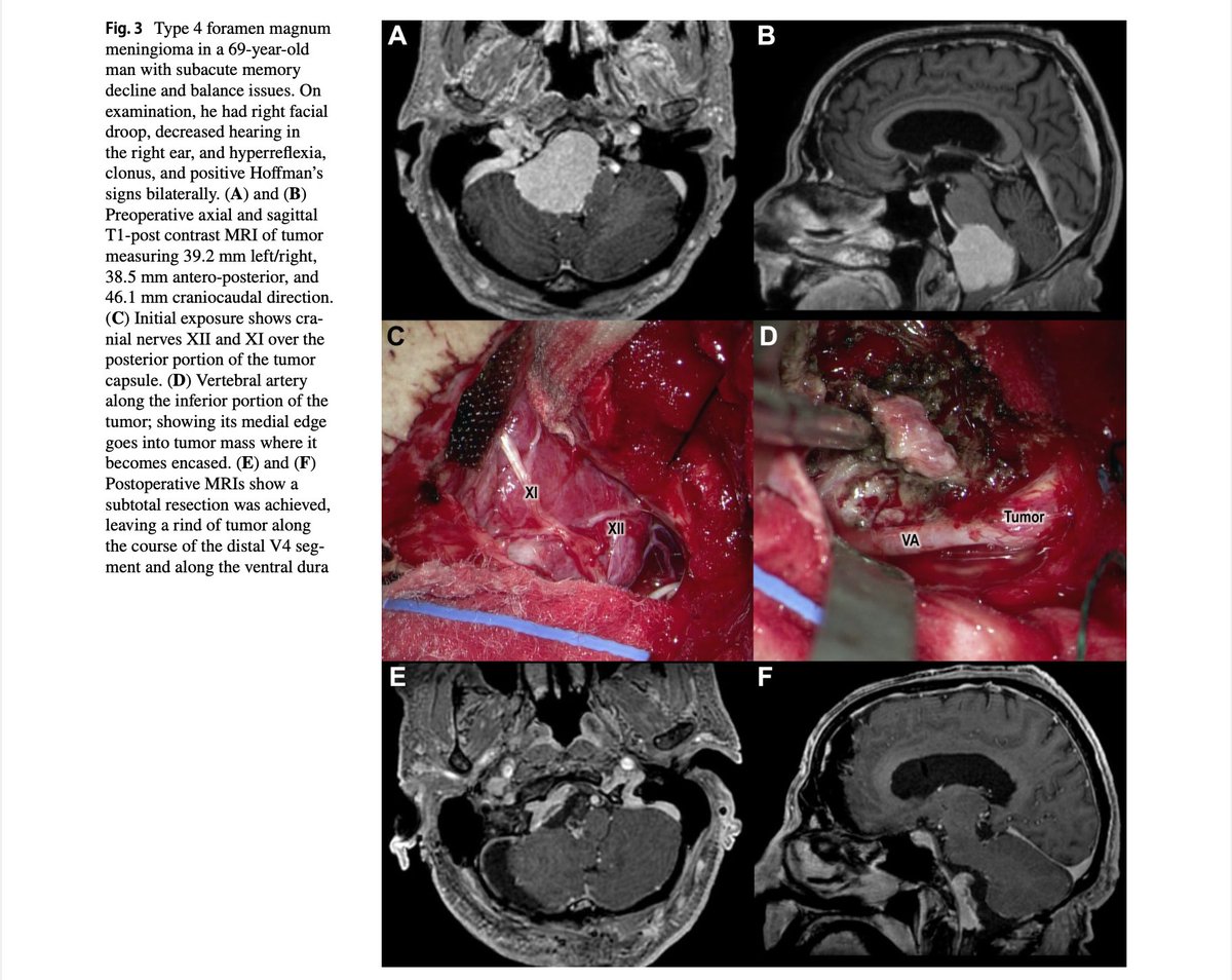 We're thrilled to share our latest research This classification seeks to link the tumor's position relative to the neurovascular bundle with the complexity of the surgery, the extent of tumor removal, potential complications, and overall clinical outcomes #meningioma #skullbase