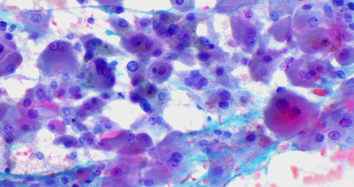 Classic example: Architectural and cellular features of Thyroid oncocytic neoplasm (Pap stain) #cytology #cytopathology