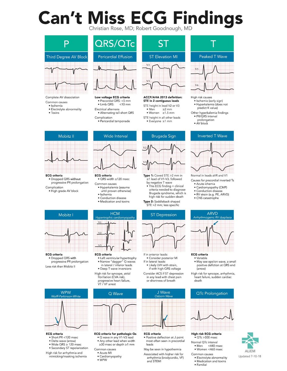 🔴Can’t Miss ECG Findings for the Emergency Medicine Provider aliem.com/cant-miss-ecg-… #Diagnosis #Cardiology #ECG #EKG #CantMiss #RedFlags #ALiEM #MustKnow #STEMI #equivalent #MedX #MedTwitter #CardioTwitter #medx #medEd #MedTwitter #MedEd #cardiotwitter #FOAMed #CardioEd