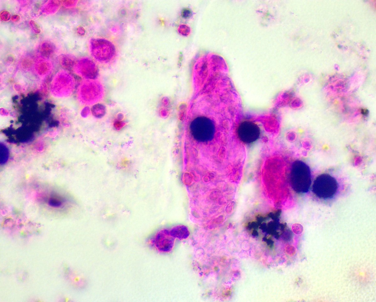 RBC casts under oblique illumination 500x oil immersion (stain: 1,3 SM; 2,4 PB). Last cast with WBC (dark blue). Unexpected #UrinarySediment in AKI, context: mantle cell lymphoma, poor po intake. Findings show that neither ischemic ATI nor TLS r likely culprit. W/u in progress