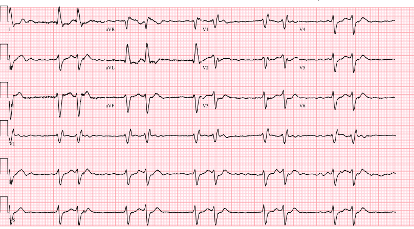 Mechanism of this bigeminy rhythm? #EPeeps #ECG