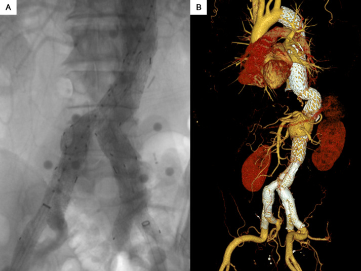 Hamza Hanif (@hamzahanifmd) on Twitter photo Fascinating to witness non-fluoroscopic intravascular navigation in complex aortoiliac reconstructions. Long way to go!
<a href="/JVascSurgCIT/">JVS-Cases Innovations and Techniques</a> <a href="/alirana1/">Muhammad Ali Rana</a>
jvscit.org/article/S2468-… Fascinating to witness non-fluoroscopic intravascular navigation in complex aortoiliac reconstructions. Long way to go!
<a href="/JVascSurgCIT/">JVS-Cases Innovations and Techniques</a> <a href="/alirana1/">Muhammad Ali Rana</a>
jvscit.org/article/S2468-…