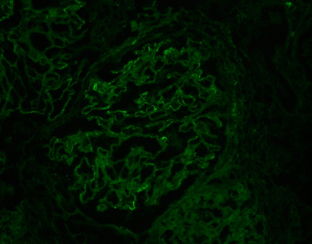 Example of treated chronic membranous nephropathy but persistent proteinuria. Spikes/luecencies on silver stain. Minimal IgG+ on IF. Mostly resorbed deposits on EM (stage 4/4) with very remodeled GBM -> ongoing proteinuria without 'active' deposits. #renalpath #nephrology