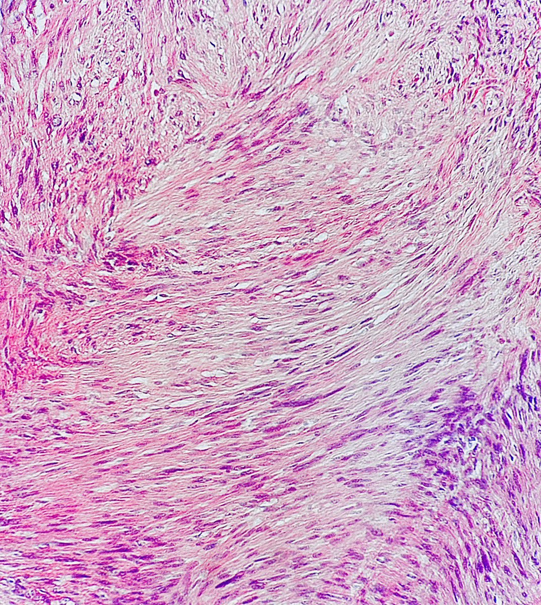 Neurofibroma

•Benign nerve sheath tumor
•Neoplastic cell is schwann cell (other associated cells- perineurial and stromal cells)
•Subtypes: ancient, cellular, atypical, plexiform👇 
•Plexiform is multinodular, look like “bag of worms”, ass w NF1+risk of MPNST transformation