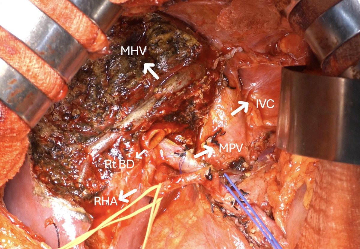 Try to expose full middle hepatic vein in left hemihepatectomy for Bismuth IIIB PCC
