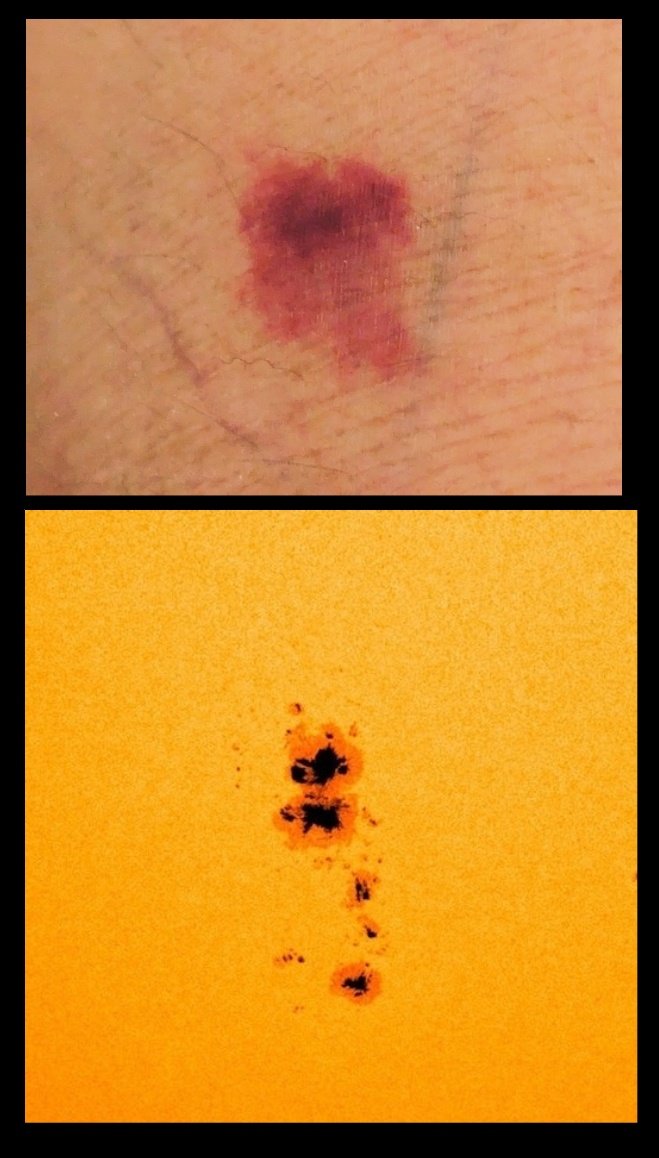 hello and happy weekend everyone 

sharing this artwork 'blemishes', a diptych of my skin and an image of sunspots