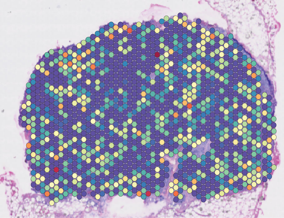 Tumor-produced lactate can drive the development of mature regulatory dendritic cells bearing the CD63 cell surface marker that suppress anti-tumor T cell responses, according to a new @SciImmunology study. scim.ag/75m