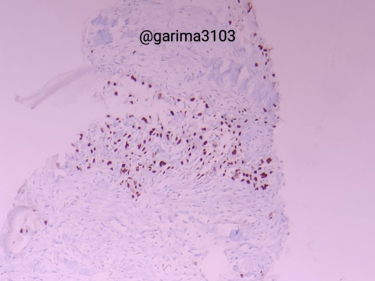 Follow up- 
Mets of Unknown Primary (PET scan- no primary except this nodal mass)
IHC 
p40+, p63+, p16-, EBER -
HPV independent, EBV independent SCC 
#pathtwitter #headandneckpath #pathology #Pathfinder