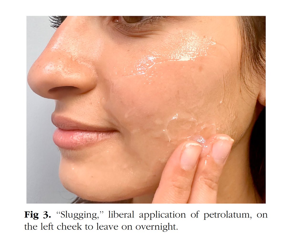 Interesting review article on Petroleum Jelly, the most underrated skin care product on the market. 'Slugging' has brought back this unsung hero of moisturization: pubmed.ncbi.nlm.nih.gov/37315800/