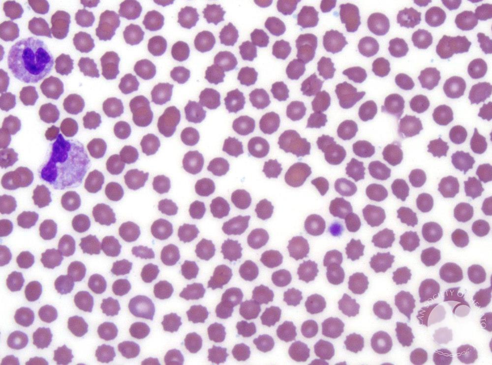 Often on the #NEETPG 👇🏼

Image 1: Acanthocyte➡️irregularly spaced projections ➡️ membrane lipid abnormality ➡️liver disease.

Image 2: Echinocyte➡️regularly spaced projections➡️end stage kidney disease.

Acanthocyte: central pallor❌
Echinocyte: central pallor✅

#MedTwitter