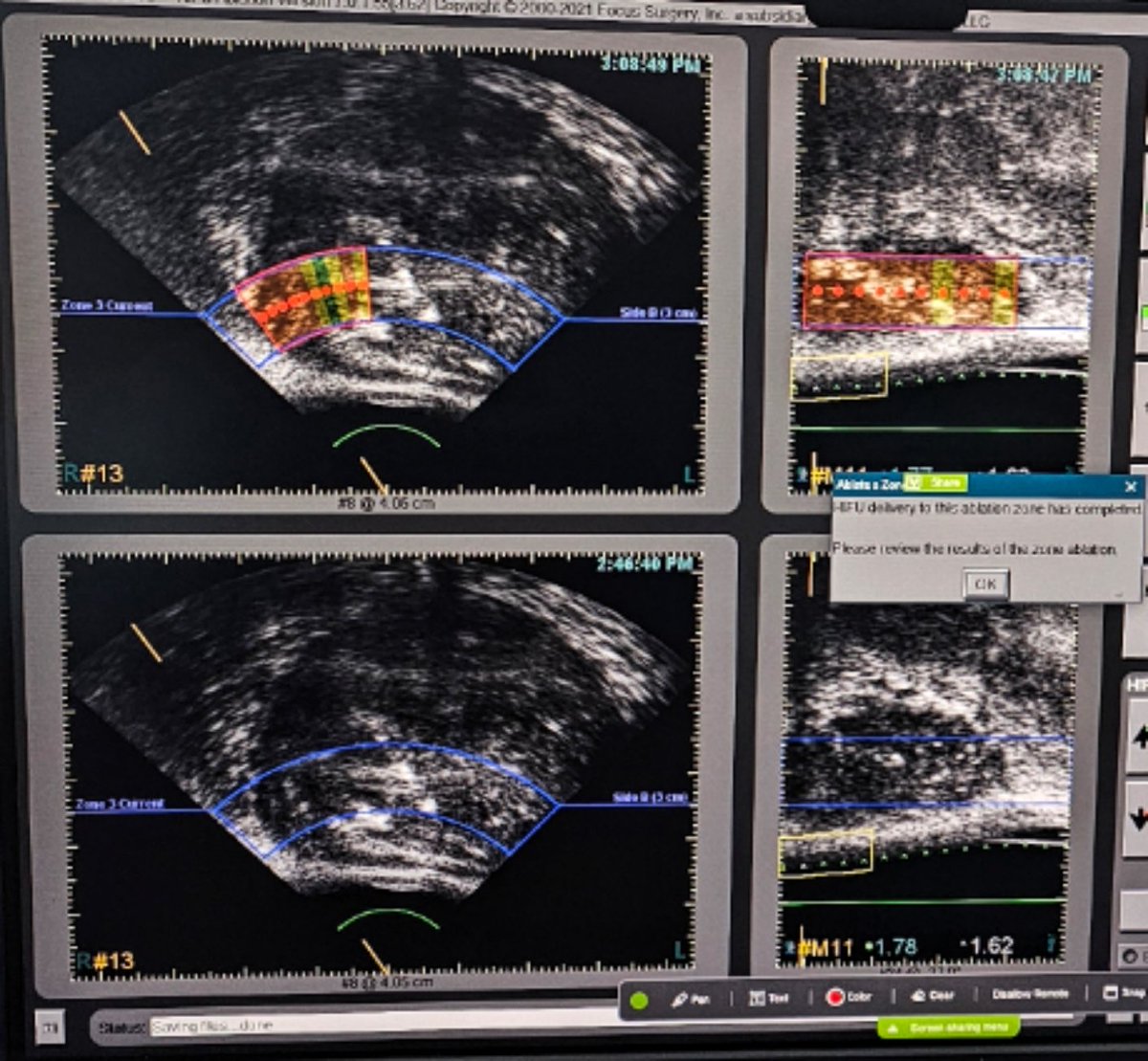 dr_dublin's tweet photo. Had a nice day today watching Mr Siva, Consultant Urologist from Ipoh GH,  performing HIFU for prostate cancer at Pantai Ipoh Hospital.
#Sonablate

Also present was Mr Murali from Sunway Medical Center. 

HIFU - it's a good alternative / option to surgery or radiotherapy. https://t.co/kS5KbigYDE