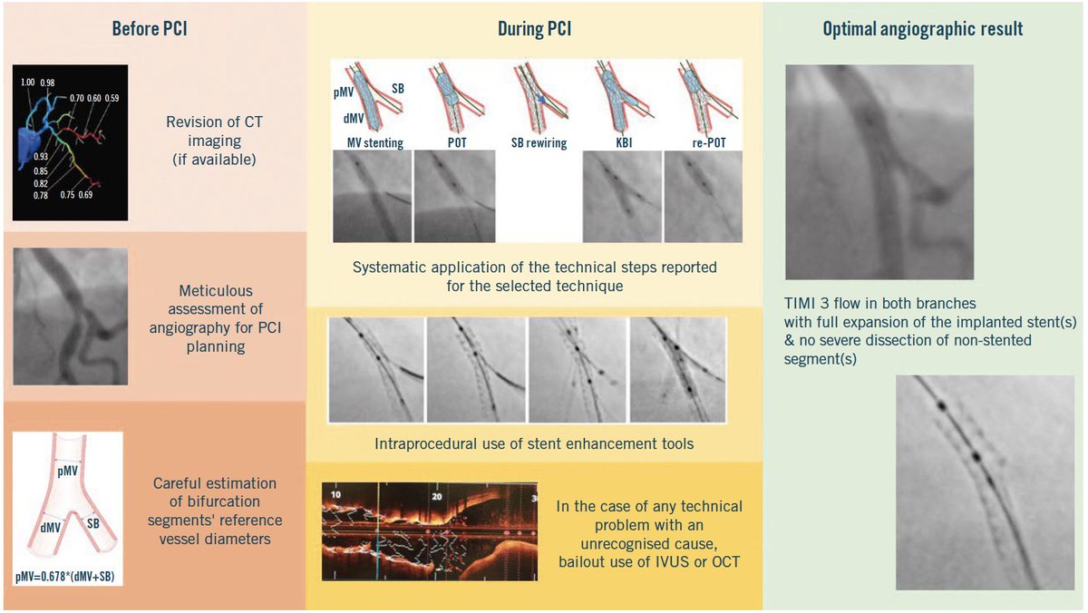 Riccardo Rinaldi (@riccardo_rin) on Twitter photo Useful tips from 18th #EBC consensus:
- when multiple inflations, proximal-to-distal #POT to prevent stent elongation;
- 'POT-puff sign' to check for adequate POT balloon diameter.
- 'stent underdeployment' for #LM/#pLAD and significant size mismatch.
<a href="/EuroInterventio/">EuroIntervention</a> <a href="/PCRonline/">PCRonline 🫀</a> Useful tips from 18th #EBC consensus:
- when multiple inflations, proximal-to-distal #POT to prevent stent elongation;
- 'POT-puff sign' to check for adequate POT balloon diameter.
- 'stent underdeployment' for #LM/#pLAD and significant size mismatch.
<a href="/EuroInterventio/">EuroIntervention</a> <a href="/PCRonline/">PCRonline 🫀</a>