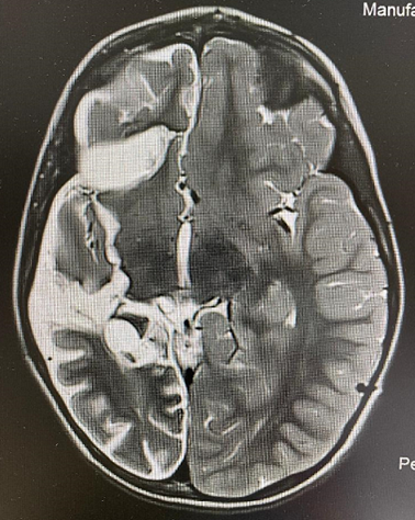 It has been a great pleasure to participate in the Congress of the Spanish Society of Neurosurgery held in Malaga, presenting my new technique of totally disconnective hemispherectomy isolating the insula by the claustrum. #hemispherectomy; #epilepsy; #neurosurgery; #innovation;