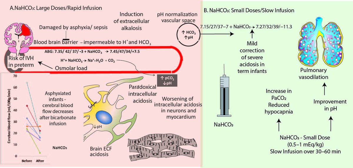 Is sodium bicarbonate therapy baseless in the NICU? Should this be banned from NICU formulary? Do you ever use it in a baby with metabolic acidosis, hypocapnia and HIE? @SankaranDeepika mdpi.com/2813786