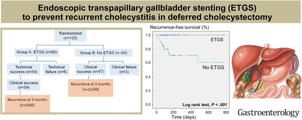 Nadeem Tehami (@helpatologist) on Twitter photo CBD calculi, cholangitis & calculus cholecystitis, unclear fitness for cholecystectomy.
Would this excellent RCT in 🦠 🕰️ from <a href="/BemParit/">Parit Bem Mekaroonkamol</a> guide your practice⁉️
<a href="/SyedGerdezi/">Anjum Gardezi MD</a> <a href="/BilalMohammadMD/">Mohammad Bilal, MD</a> <a href="/japariciot2/">José Ramón Aparicio</a> <a href="/Stentingwoman/">Tamta Chkhikvadze</a> <a href="/huggett_matthew/">Matthew Huggett</a> <a href="/NEndoscopy/">Prof John Leeds</a> CBD calculi, cholangitis & calculus cholecystitis, unclear fitness for cholecystectomy.
Would this excellent RCT in 🦠 🕰️ from <a href="/BemParit/">Parit Bem Mekaroonkamol</a> guide your practice⁉️
<a href="/SyedGerdezi/">Anjum Gardezi MD</a> <a href="/BilalMohammadMD/">Mohammad Bilal, MD</a> <a href="/japariciot2/">José Ramón Aparicio</a> <a href="/Stentingwoman/">Tamta Chkhikvadze</a> <a href="/huggett_matthew/">Matthew Huggett</a> <a href="/NEndoscopy/">Prof John Leeds</a>