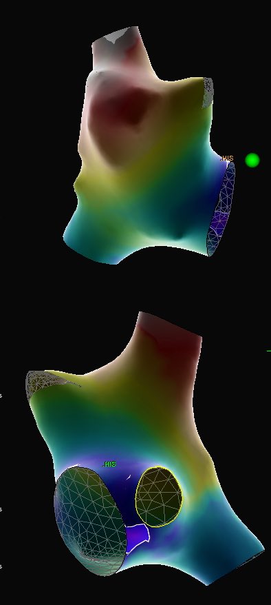 Mechanism consistent with AVNRT, we could only produce an 8 msec H-H perturbation with Single Atrial Extrastimulations from proximal CS.  
Fundamentally reset, but did not meet the 10 msec cutoff. 

Further incremental scanning of SAE did however terminate tachycardia with AH