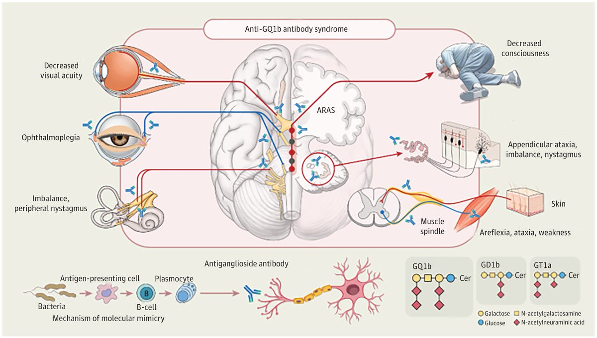 Most viewed in the last 7 days from @JAMANeuro: This narrative review describes the phenotypes of anti-GQ1b antibody syndrome to aid in its diagnosis in light of its various clinical presentations. ja.ma/44W5u4Y