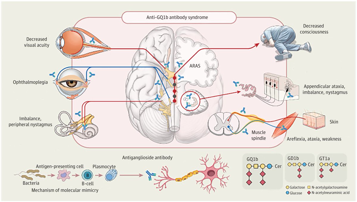 JAMA Neurology (@jamaneuro) on Twitter photo Most viewed in the last 7 days from <a href="/JAMANeuro/">JAMA Neurology</a>:
This narrative review describes the phenotypes of anti-GQ1b antibody syndrome to aid in its diagnosis in light of its various clinical presentations.
ja.ma/44W5u4Y Most viewed in the last 7 days from <a href="/JAMANeuro/">JAMA Neurology</a>:
This narrative review describes the phenotypes of anti-GQ1b antibody syndrome to aid in its diagnosis in light of its various clinical presentations.
ja.ma/44W5u4Y