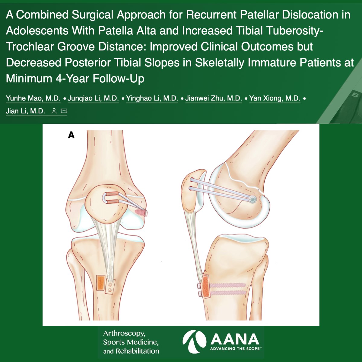 Anatomic MPFL reconstruction and tibial tuberosity transfer in adolescents with patella alta and elevated tibial tuberosity-trochlear groove distance in the treatment of recurrent patellar dislocation resulted in improved knee function. #PatellarDislocation