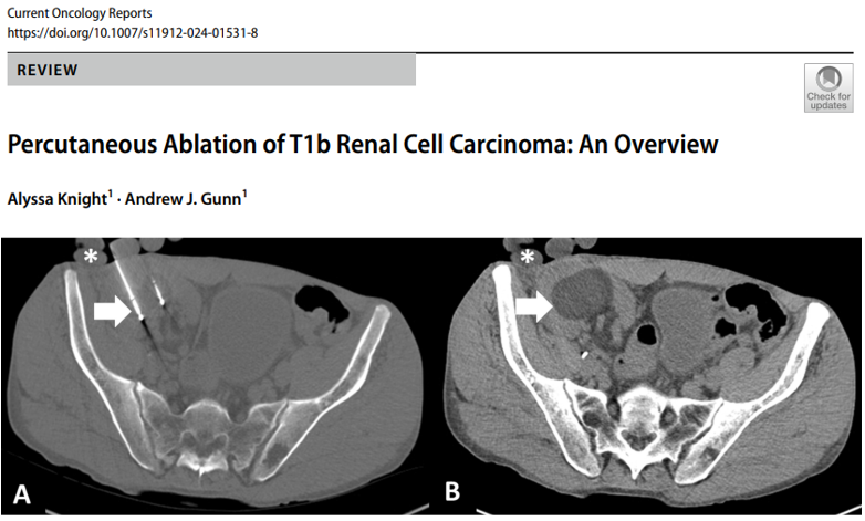 As #InterventionalOncology section editor for Current Oncology Reports, I would like to share an article that is hot off the press! Important work by Drs. Alyssa Knight and @ajgunnmd from @uab_ir on the current role of percutaneous ablation of T1b #renalcellcarcinoma. Due to