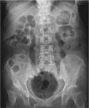 #Emphysematous_pyelonephritis
 (EPN)is an acute severe necrotizing infection of the renal parenchyma and its surrounding tissues that results in the presence of gas in the renal parenchyma,collecting system,or perinephric tissue. It occurs due to GNB infection 
in DM

#MEDHM