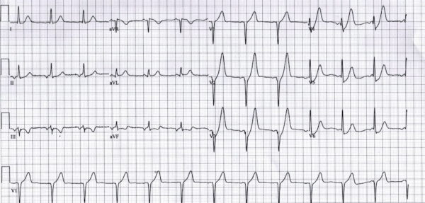 A case of deceptive discomfort and an ECG that hides a lethal secret. de Winter T-waves signal an imminent threat, a storm brewing in the heart's own LAD. Are we prepared to act before the first snowfall? litfl.com/winter-is-comi… #FOAMed #MedEd #MedTwitter #CardioTwitter