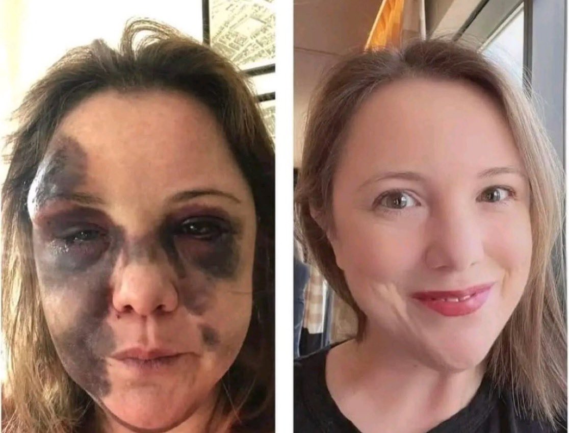 feelgoodtale's tweet photo. Hi! My name is Harriett. I’ve come a long way. I’m 2.5 years sober. Before sobriety, alcohol owned me. I could not imagine going one day without it. Now, I’m thriving and living the best sober life - for life!
People often cannot fathom how much I drank in a day. Frankly, I cannot fathom it. My life revolved around alcohol. Then one day, I started having seizures from alcohol withdrawal. That’s where this bruised pic comes in. What should have just been a bump on my forehead from the fall was unbelievable bruising because my body was not properly functioning.
I turned it all around post-seizure. I went to a treatment facility and made an effort to attend AA.
AA saved my life.
Today I am flourishing and am so grateful for my acceptance that I am an alcoholic. I am also grateful for my willingness to turn it over to my Higher Power.