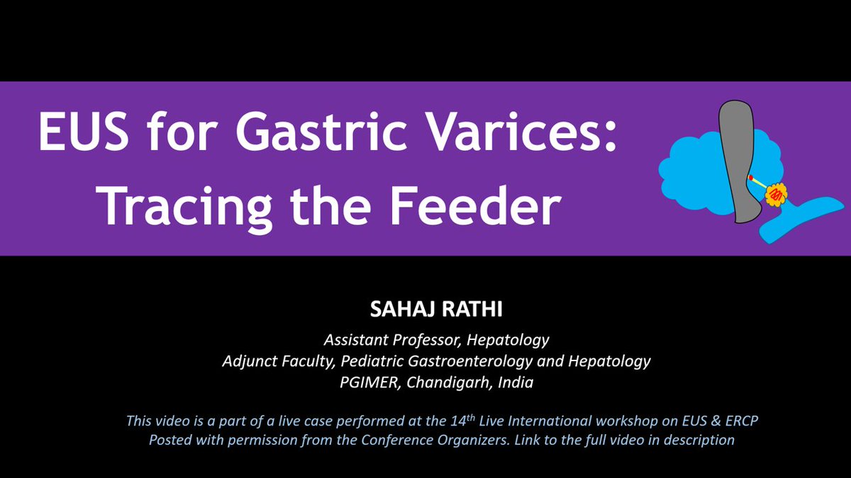 Teaching 📹 EUS for Gastric Varices: How to trace the feeder? youtu.be/nlu-0fa8vsU #GITwitter #Endohepatology