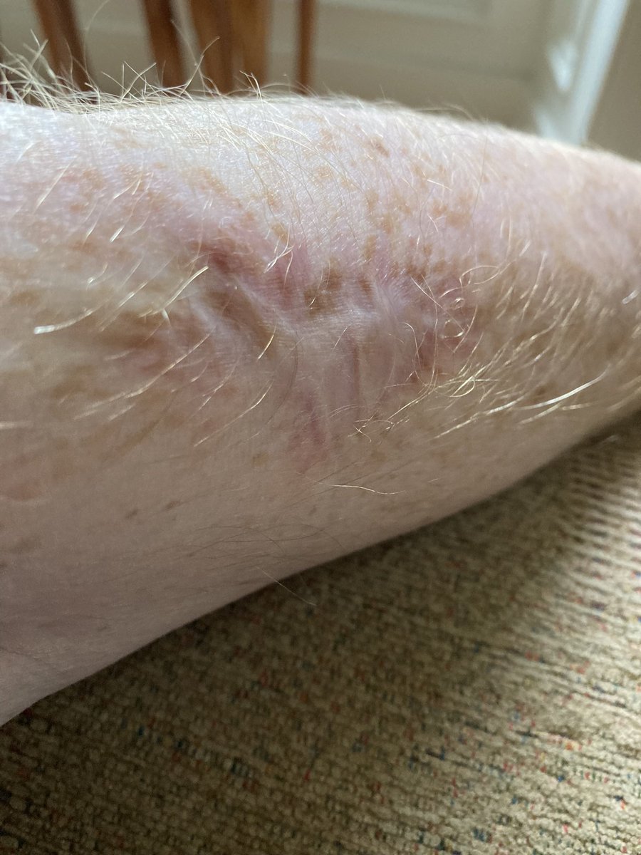 May’s Melanoma awareness month & this is my Melanoma scar. What you can’t see are 2 tumours I developed internally which led to stage 4 incurable cancer diagnosis, but thankfully Immunotherapy is keeping that under control. Please look after your skin, it’s your largest organ.