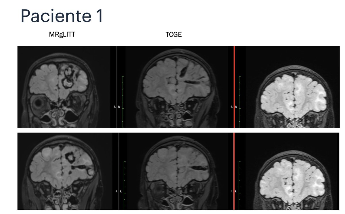 EpilepsiaHRuber's tweet photo. Nuestra compañera la Dra. Irene Sánchez-Miranda muestra como la ESI puede guiar en la termocoagulación y ablación láser en pacientes con esclerosis tuberosa. En la reunión anual de la sociedad española de neurología pediátrica: https://t.co/wCMxyqszg9
@tscalliance @UKTSA https://t.co/OHfvBuMfAT