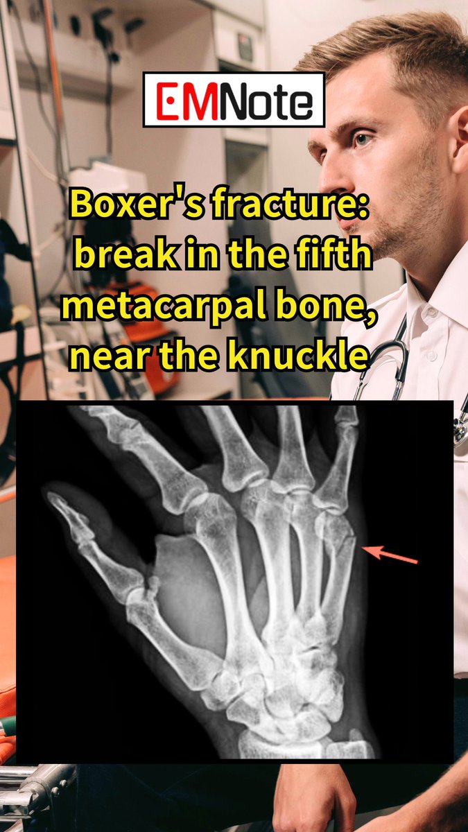 Boxer's Fracture. youtube.com/shorts/VATyxGE… A boxer's fracture is a break in the 5th metacarpal bone near the knuckle. It is the most common type of metacarpal fracture. It occurs when a boxer punches someone or something with a closed fist.