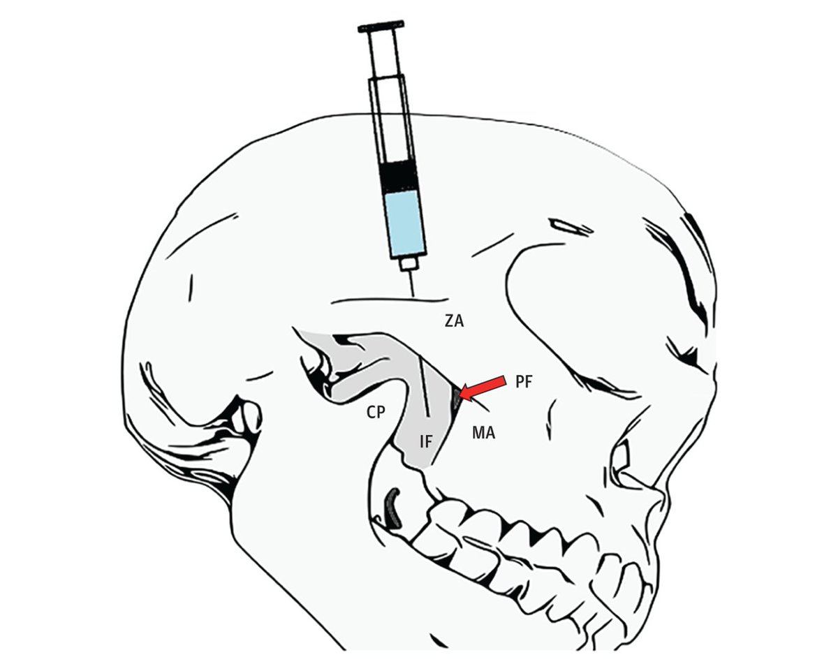 Randomized clinical trial serves as a pilot study and provides evidence that supports integrating suprazygomatic maxillary nerve blocks in the perioperative pain management protocol for pediatric intracapsular adenotonsillectomy. ja.ma/4bN2SIS