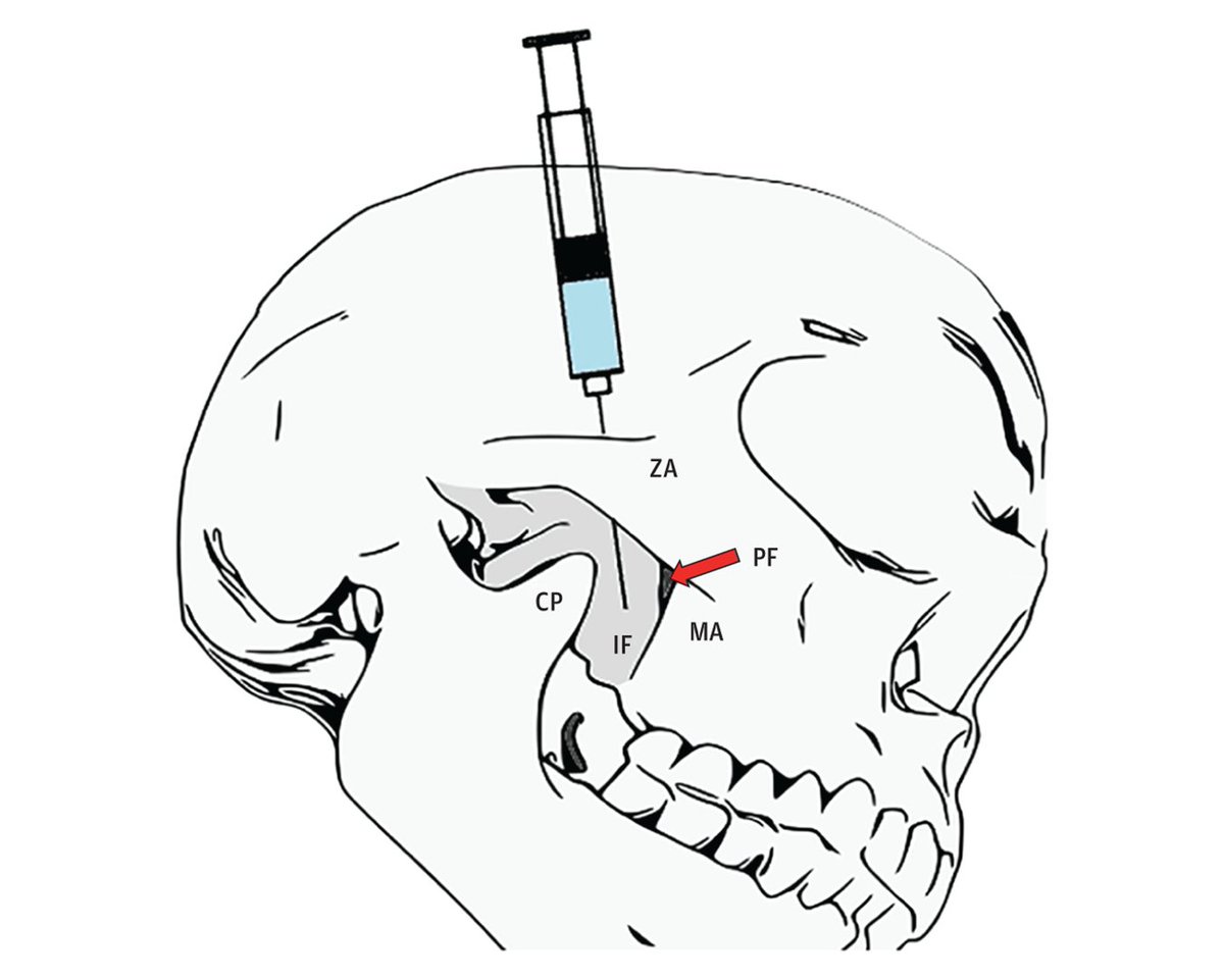 Randomized clinical trial serves as a pilot study and provides evidence that supports integrating suprazygomatic maxillary nerve blocks in the perioperative pain management protocol for pediatric intracapsular adenotonsillectomy. ja.ma/4dVqKM8