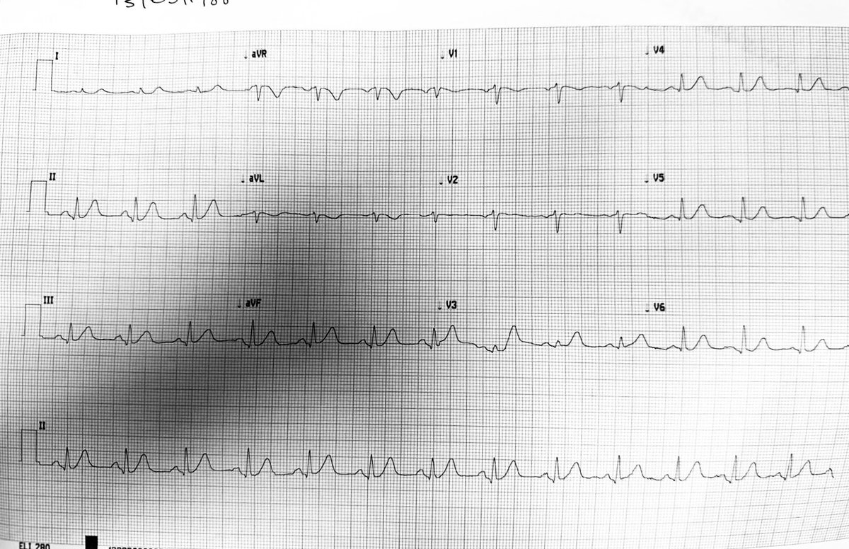 “Check out this intriguing EKG of a 36-year-old female who comes to the ED with retrosternal chest pain radiating to both arms.. Would you activate the cath lab immediately? What’s your take on culprit vessel ? #Cardiotwitter @smithECGBlog @EM_RESUS @amalmattu @ShariqShamimMD