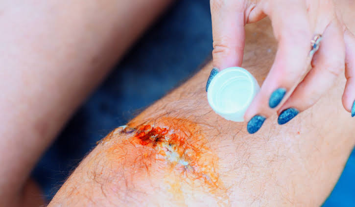 Guys, alkohol tuh emg efektif banget buat matiin bakteri. Tapi JANGAN dipake buat bersihin luka terbuka!

Selain emang bakal perih banget, ngasih alkohol ke luka bisa merusak jaringan sehat di sekitar situ.

“Terus gimana dong?”

Simak utas ini ya! Aku jelasin.