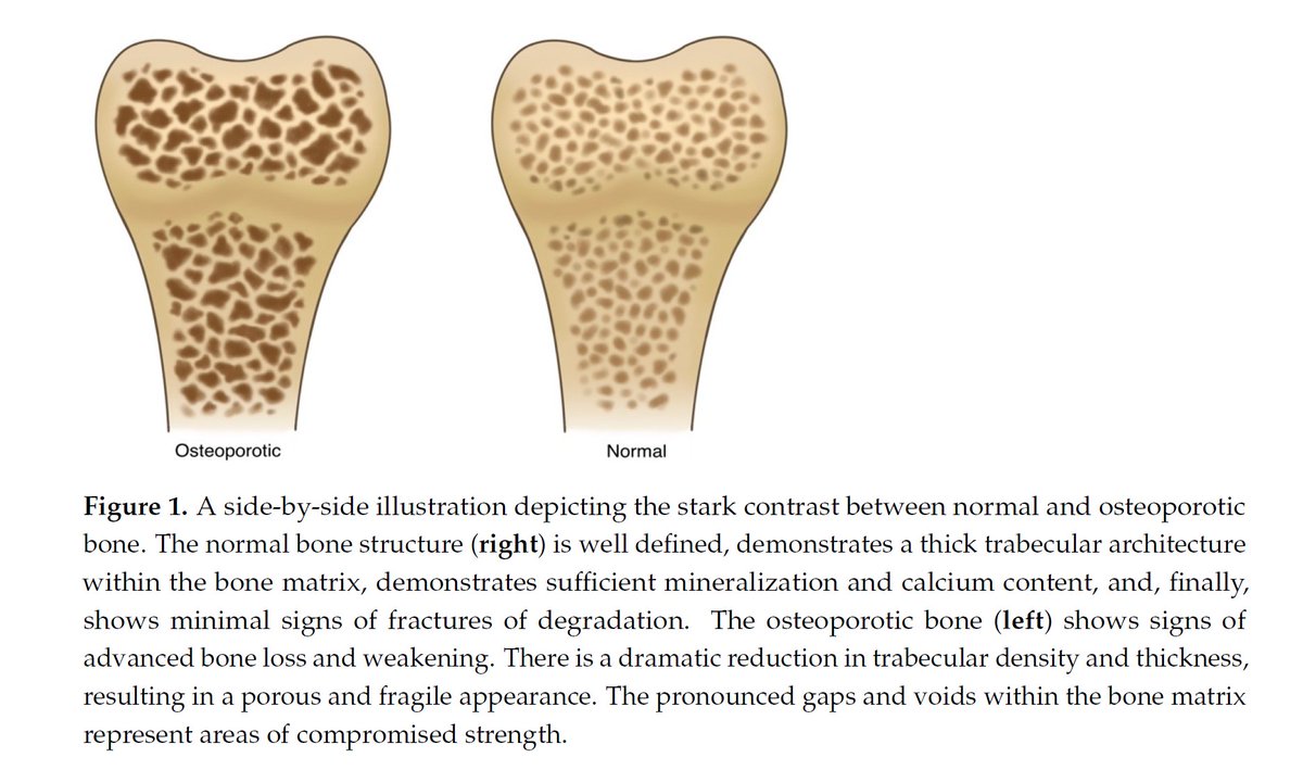 FF_Network's tweet photo. 🦴 Osteoporosis: narrative review

♦️ Molecular pathology

♦️ Diagnostics

♦️ Therapeutics

🔗 https://t.co/TrqKUVRG5s

#osteoporosis #fragilityfracture #hipfracture #vertebralfractures https://t.co/9NnCS9RFzj