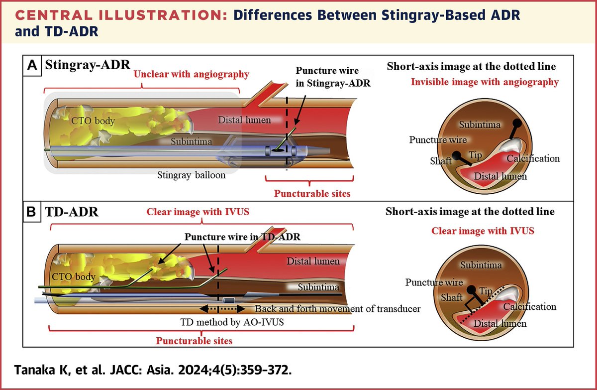 Tip detection-antegrade dissection re-entry (ADR) by CP12ST wire can standardize highly accurate ADR in #CTO-#PCI. bit.ly/3QWGZyM 👓 the editorial: bit.ly/4bNfoba 🎧 to the #JACCPodcast: bit.ly/4bvzRBT #JACCAsia @AOkamura5