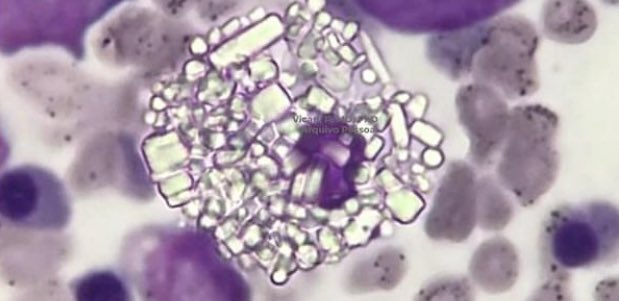 Patient with chronic anemia and massive spleen. Diagnosis?