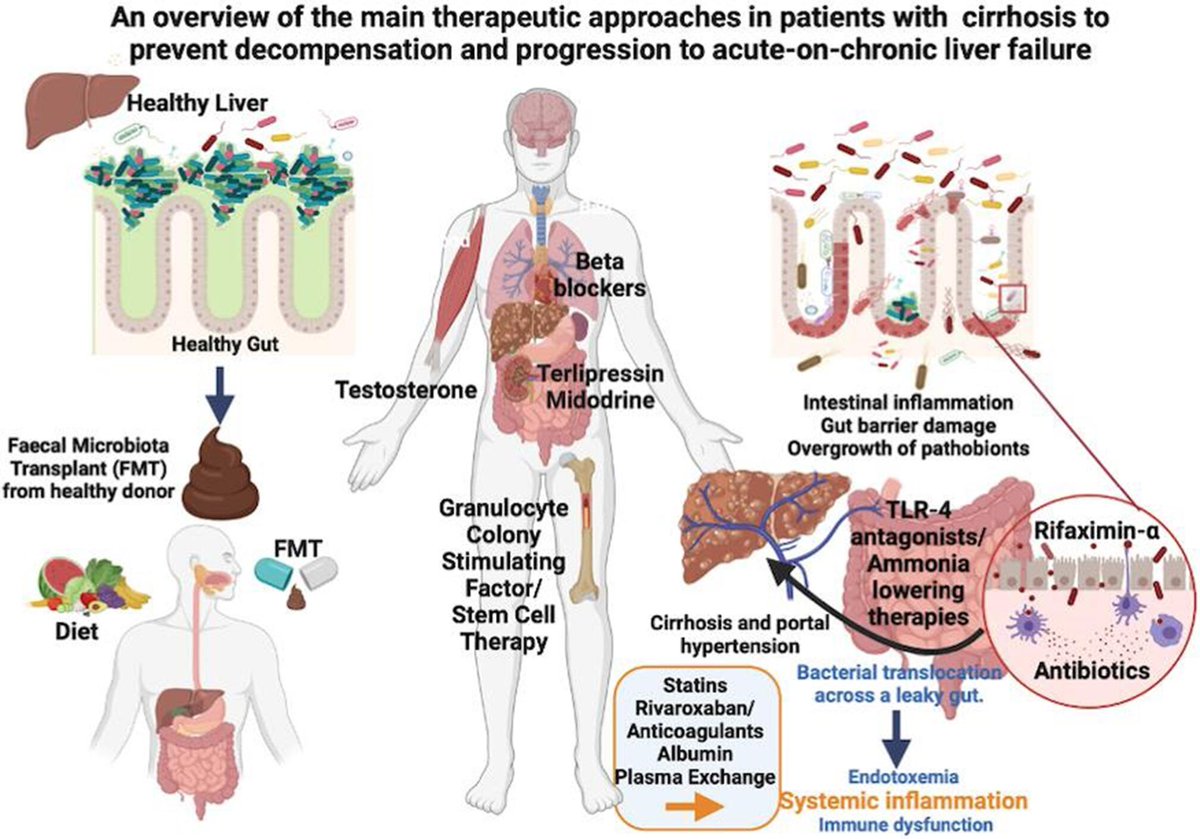 #GUTImage from the #RecentAdvancesInClinicalPractice paper by @JonelTrebicka et al entitled 'Recent advances in the prevention and treatment of decompensated cirrhosis & ACLF & the role of biomarkers' via bit.ly/3URhCjc @ruben_hernaez @DebbieShawcros1 @AlexanderGerbes