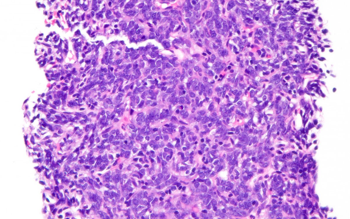 KyleDPerryMD's tweet photo. Synovial sarcoma, an underestimated mimicker... #BSTpath, #UMichPath, #BSTpathGoBlue https://t.co/jW7gxzkqEL