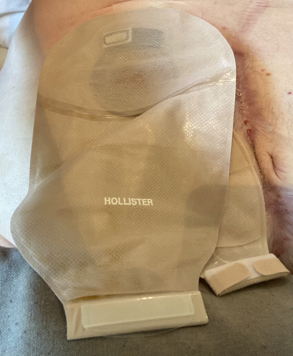 New bags fresh on 🙂.
Seeing my surgeon next week. May be a talk about my ileostomy being changed to a stoma; or a full re-join to no bags at all. May not be able due to lots of scarring off 2 unsuccessful ops. Advice pls
Is an ileost to stoma op worth the risk? #ostomates #stoma
