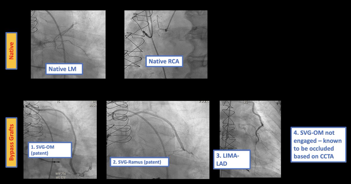 🧵How to use #yesCCT data to perform low contrast coronary angiogram 👇 📌Patient below w/ #CKD, unknown graft anatomy. Used prior CT data to perform cor angio + bypass graft angio with minimal dye🪡 Read 8 pointers below🧵1/4 #CardioTwitter #ACCFIT #Cardiology #MedTwitter